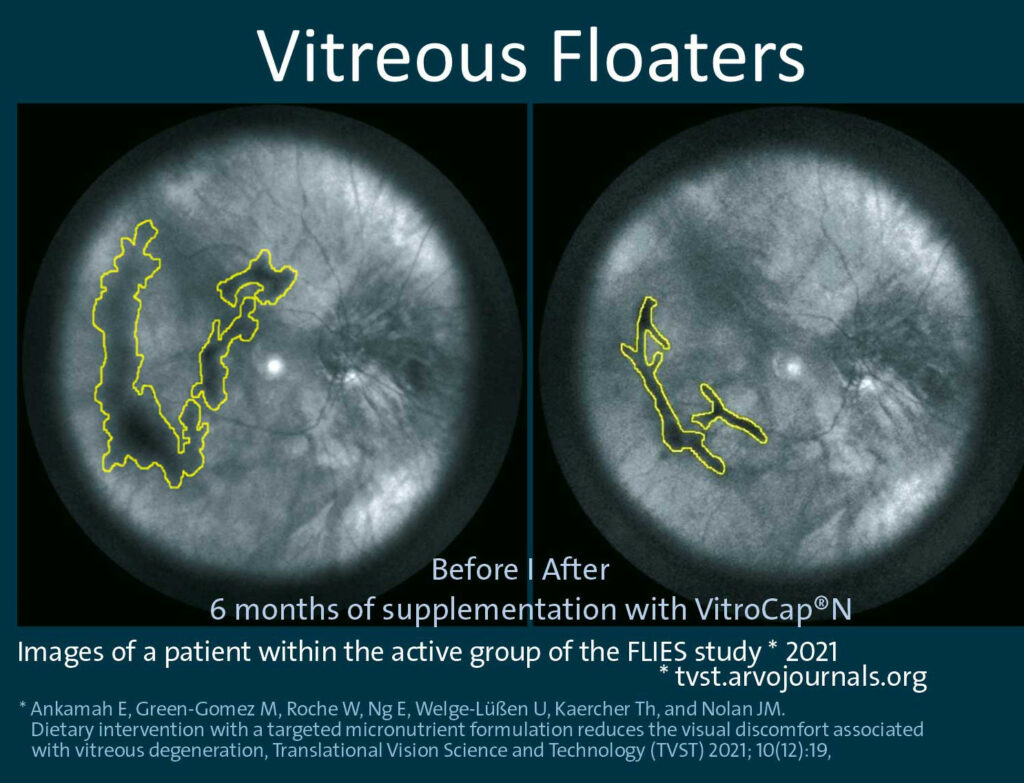 vitrocap n study results supplement for eye floaters