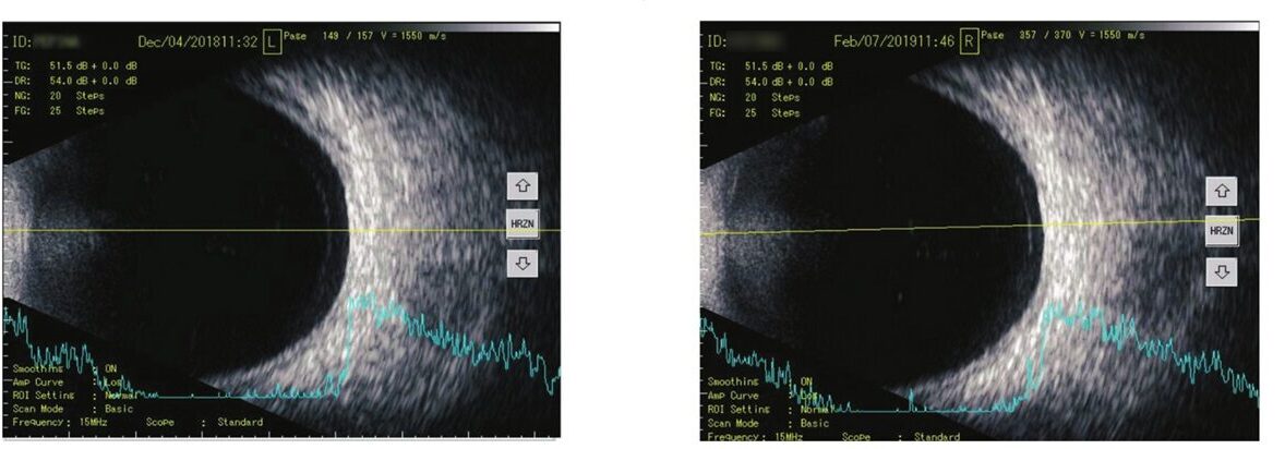 VitroCapN studie 2019 Auswertung B Scan Trübungsbereich