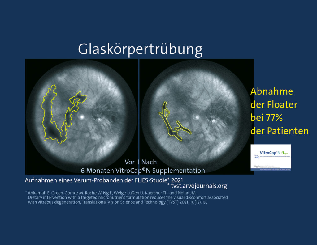 VitroCap Wirkung Vitamine Glaskörpertrübung